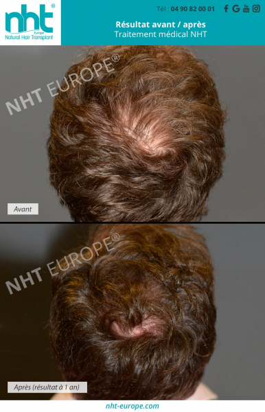 Traitement alopecie PRP après 1 an