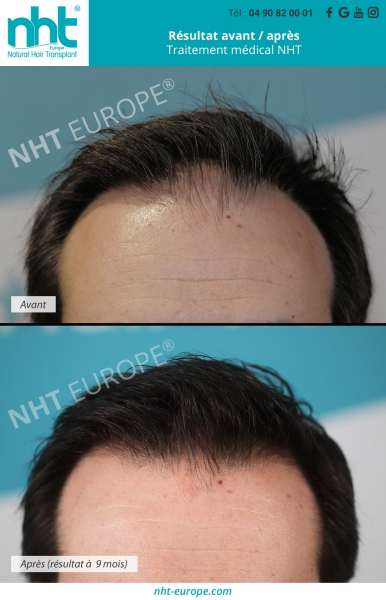 traitement-contre-la-perte-de-cheveux-calvitie-alopecie-areata-pelade-trichotillomanie-prp-mesotherapie-rigenera-injection-de-facteur-de-croissance-resultat-avant-apres-repousses