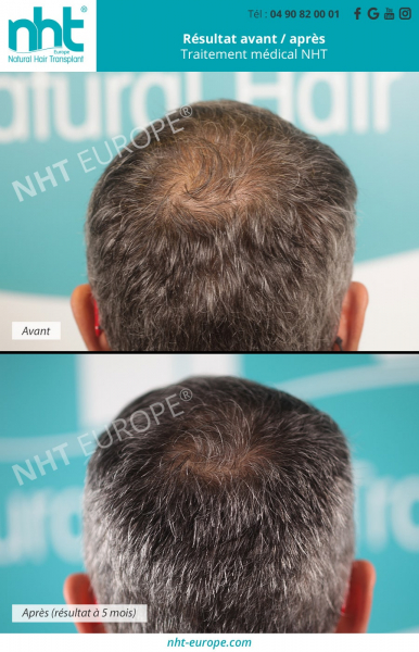 traitement-medical-prp-nanofat-facteurs-de-croissance-pousse-des-cheveux-calvitie-homme-resultats-avant-apres
