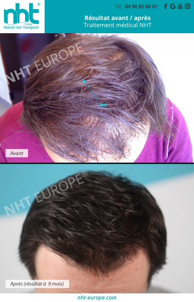 stopper-arreter-la-chute-des-cheveux-perte-calvitie-alopecie-pelade-solution-cheveux-fin-repousses-de-cheveux-epais-densité-prp-cuir-chevelu-resultat-avant-apres-mesotherapie-calecim-test-adn-fagron