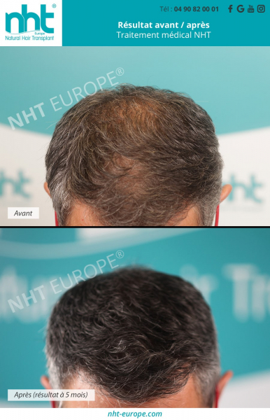 traitement-medical-anti-chute-des-cheveux-homme-solution-contre-la-calvitie-alopecie-perte-de-cheveux