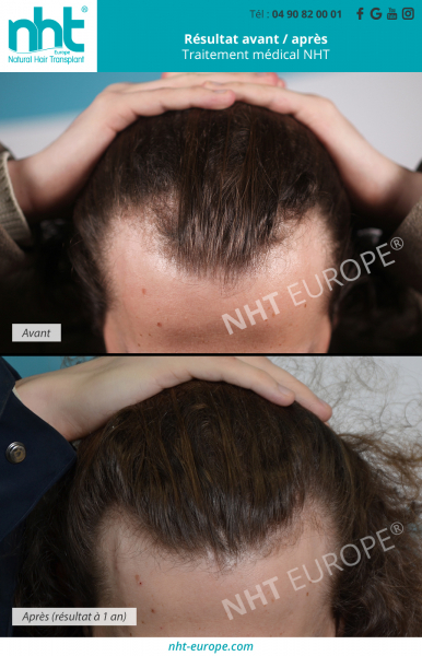 traitement-pour-arreter-la-chute-des-cheveux-repousse-solution-contre-la-calvitie-alopecie-androgenique-androgenetique-minoxidil-finasteride
