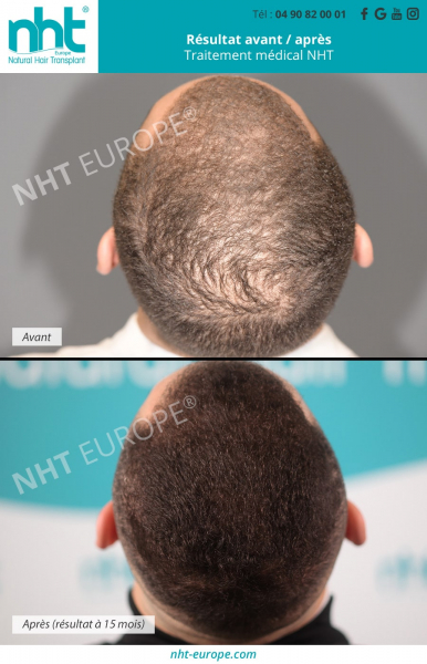 traitement-medical-contre-la-chute-de-cheveux-calvitie-alopecie-repousse-de-cheveux-resultats-a-15-mois-adn-lotion-etude-du-genome