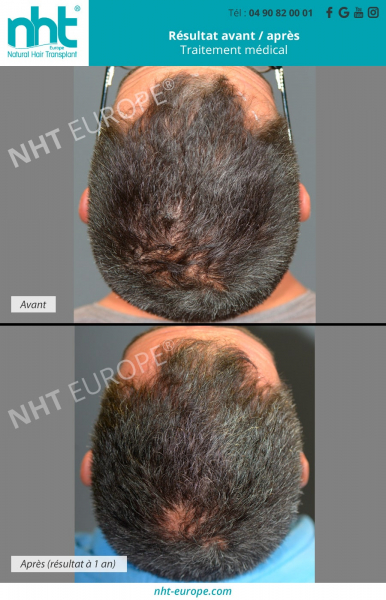 Traitement médical perte de cheveux PRP cheveux résultat après un an