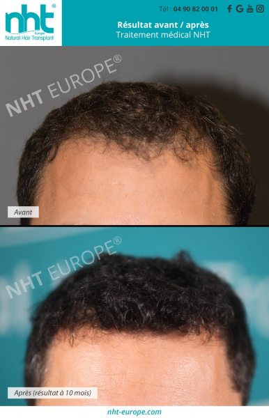 resultat-avant-apres-traitement-medical-nht-contre-la-chute-de-cheveux-alopecie-calvitie-homme-repousse-des-cheveux