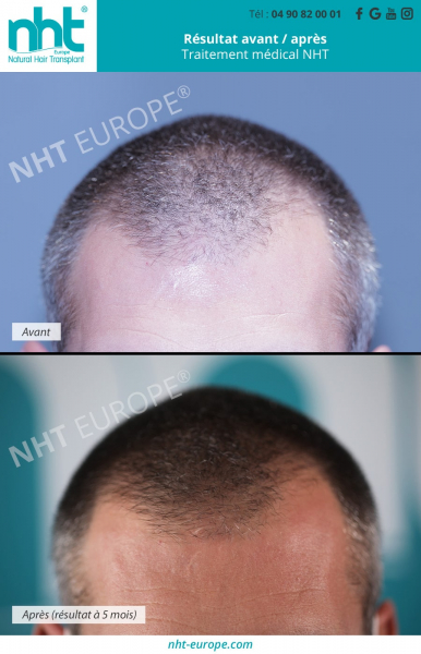 traitement-pour-arreter-alopecie-calvitie-chute-de-cheveux-ligne-frontale-injection-de-prp-adn-lotions-resultat-à-5-mois