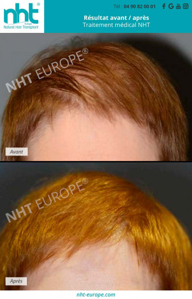 avant-apres-traitement-medical-alopecie-perte-de-cheveux-femme-prp-test-adn