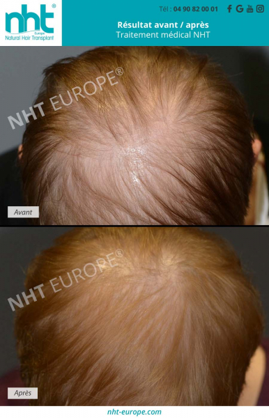 avant-apres-traitement-medical-contre-la-perte-de-cheveux-alopecie-femme-repousse-des-cheveux