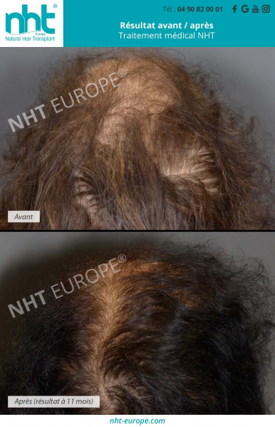 prp-solution-repousse-cheveux-traitement-medical-femme-resultat-avant-apres-11-mois-femme