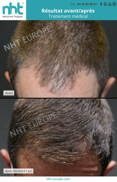 traitement-medical-calvitie-alopecie-avant-apres-1-an