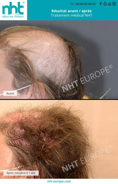 traitement-medical-alopecie-trichotillomanie-femme-resultat-avant-apres-1-an