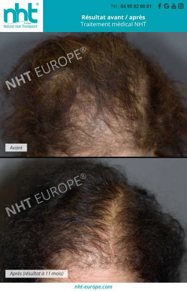 traitement-medical-prp-avant-apres-femme-pousse-des-cheveux-11-mois
