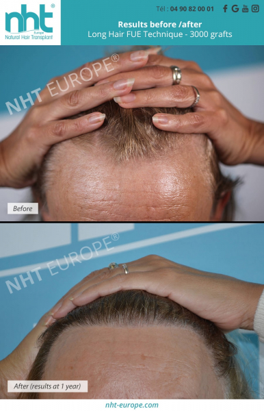 women's long hair transplant before and after results