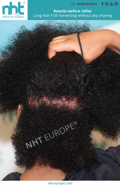long hair fue afro hair transplant procedure without cutting hair