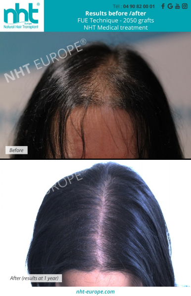 Woman hair transplant long hair without shaving 2050 grafts