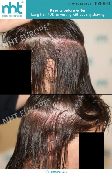 hair transplant without shaving long hair woman