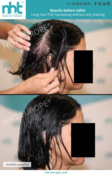 no shaving hair transplant for women