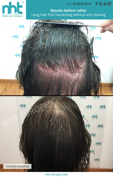 invisible harvesting hair grafting before after results long hair fue