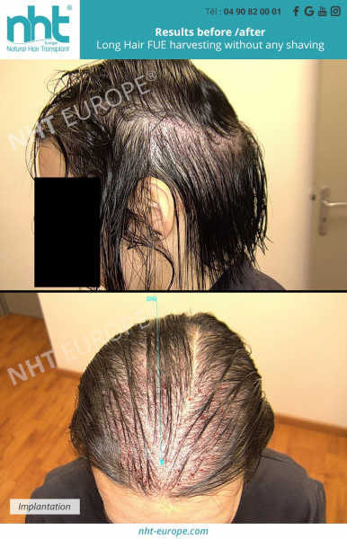 solution female hair loss hair transplant without shaving or cutting hair