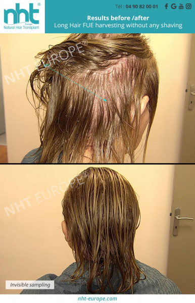 hair transplant with long hair for woman