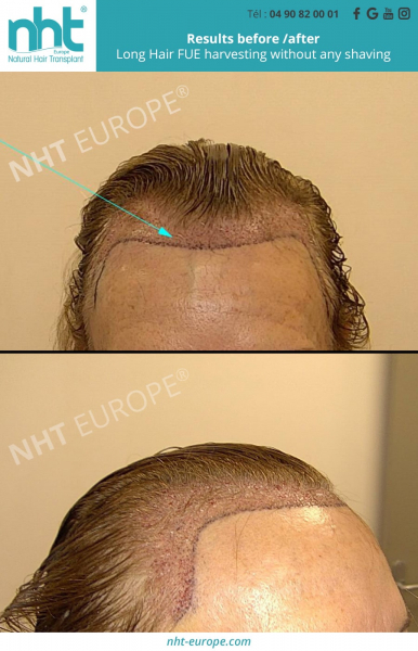 implantation of long hair fue transplants on woman
