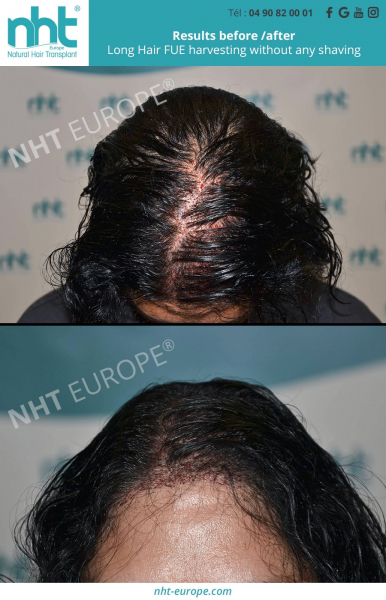 discreet implantation of hair transplant on woman long hair fue
