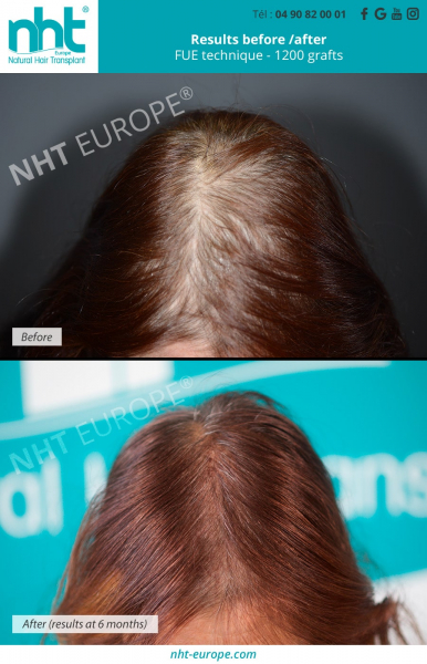 Hair transplant on woman alopecia arreata hair loss