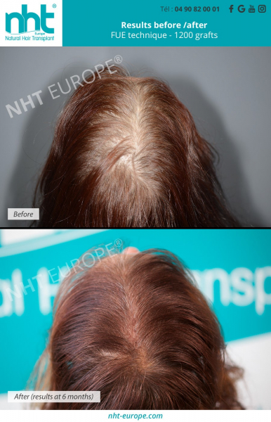 Result Hair transplant on woman 1200 grafts