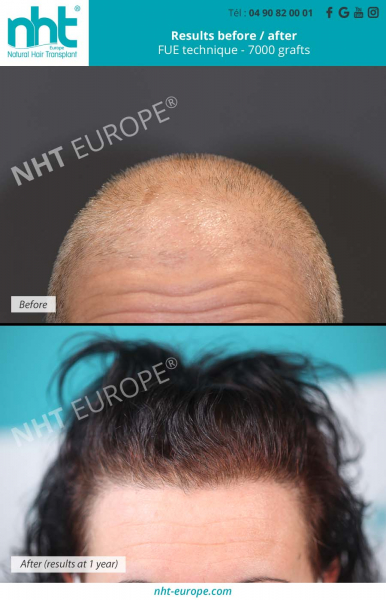 Results hair transplant woman 7000 grafts