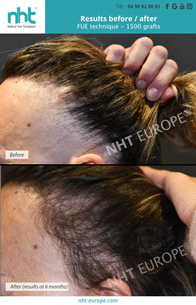 Woman hair transplantation results 1500 grafts hair growth