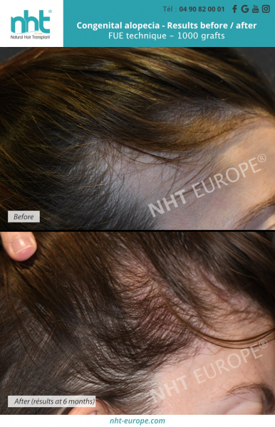 Before after results woman hair transplant long hair no shaving