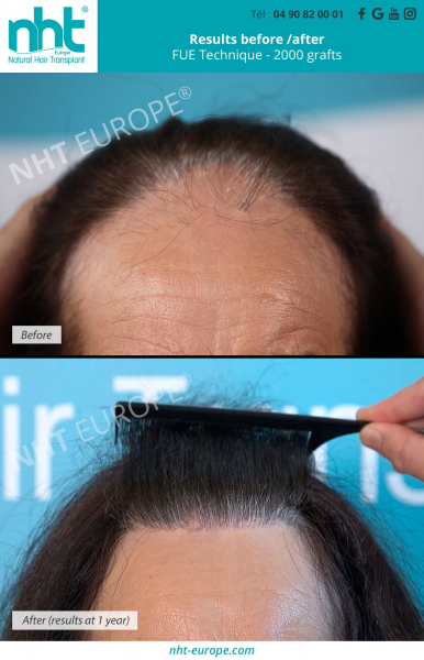 woman hair transplantation forehead before after result long hair fue dhi