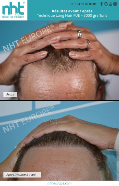 greffe de cheveux long hair femme resultat avant apres