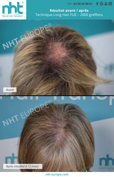 greffe de cheveux femme technique long hair fue sans aucun rasage nht europe