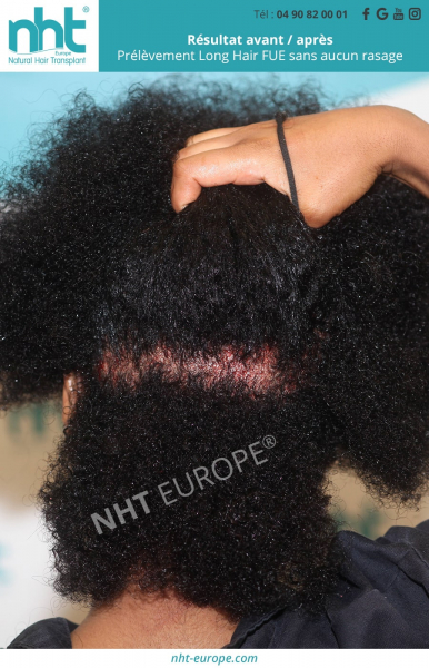 prelevement greffe de cheveux afro sans aucun rasage long hair fue