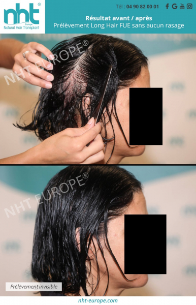 technique de greffe capillaire pour femme sans rasage cheveux longs