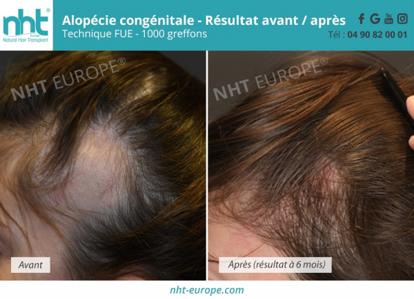 Alopecie congénitale femme chirurgie-capillaire 1000 greffons résultat 6 mois