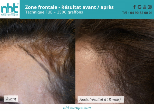 Greffe cheveux fronto temporale 1500 greffons méthode FUE