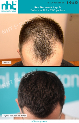 resultat-avant-apres-greffe-de-cheveux-2300-greffons-ligne-frontale-golfes-fronto-temporaux-6-mois-clinique-france-avignon-calvitie-perte-de-cheveux-alopecie-solution