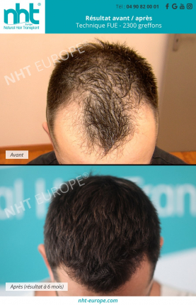resultat avant apres greffe de cheveux 2300 greffons ligne frontale golfes fronto temporaux 6 mois clinique france avignon calvitie perte de cheveux alopecie solution