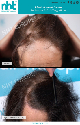 greffe de cheveux longs femme resultat avant apres alopecie solution