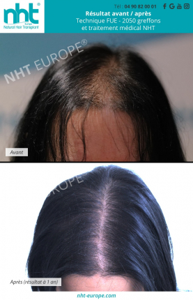 greffe-capillaire-femme-long-hair-sans-rasage-traitement-medical