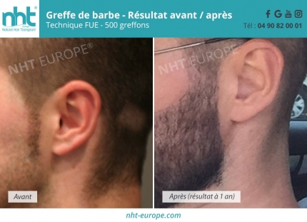 Greffe de barbe FUE 500 greffons, résultat avant-après