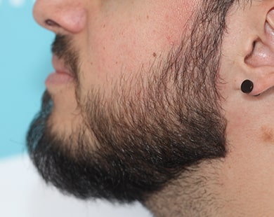 Beard transplant left side