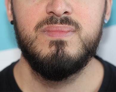 Greffe de barbe côté droit