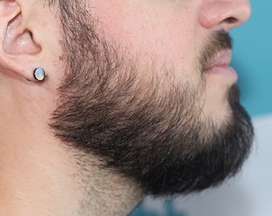 Beard transplant right side