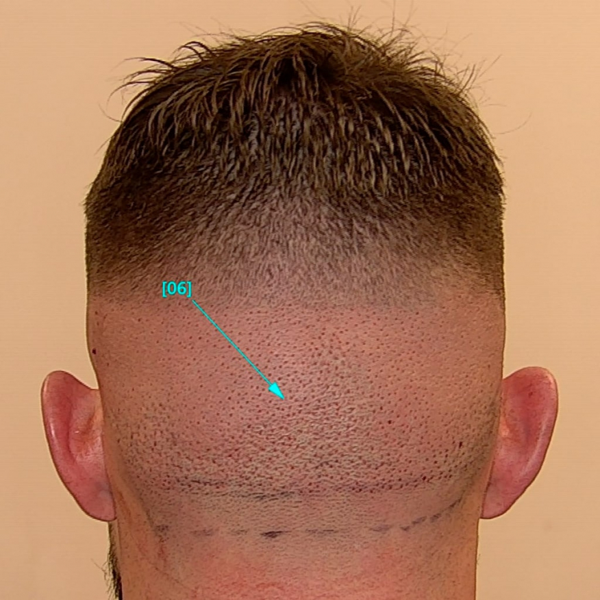 Shaving limited to the donor area