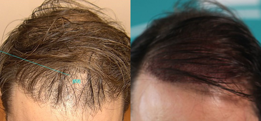 Before and after implantation