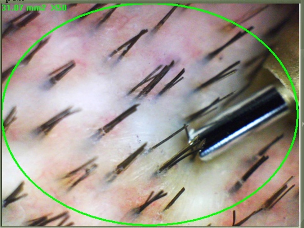 Vue microscopique de la zone donneuse avant une greffe de cheveux