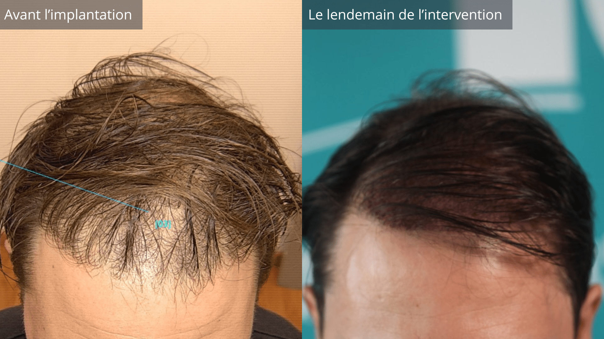 Résultat après implantation greffe de cheveux sans rasage
